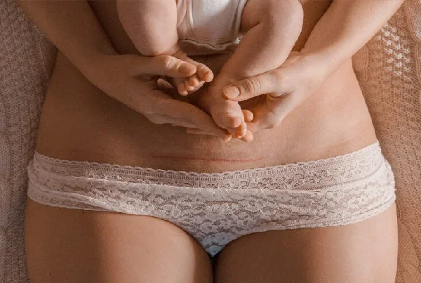 Post C Section Rehabilitation