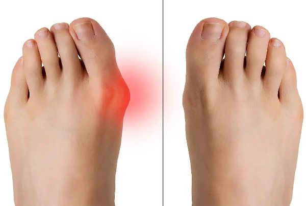 Hallux Valgus